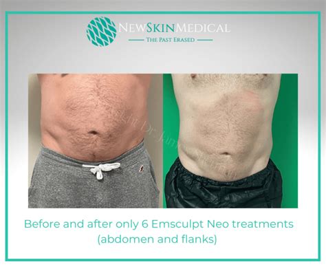 My Unfiltered Emsculpt Neo Review .